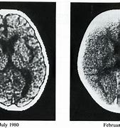 Image result for Shrunken Brain
