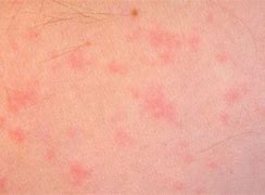 Image result for Food Allergy Skin Rash