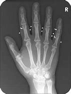 Image result for Psoriatic Arthritis Hands XR