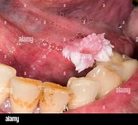 Image result for Warts in Mouth