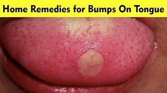Image result for HPV Spots