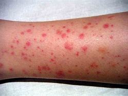 Image result for Chronic Lymphocytic Leukemia Rash