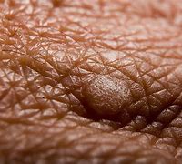 Image result for Normal Female Genital Warts