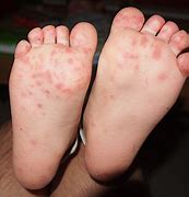 Image result for Hand Foot Mouth Disease Symptoms