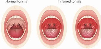Image result for Mono Tonsils