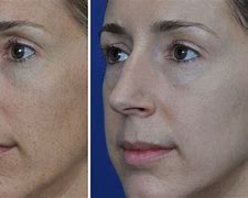 Image result for BBL Face Treatment