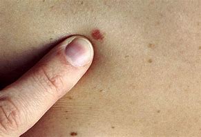Image result for Groin Skin Cancer