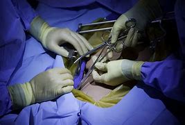 Image result for Treatment for Ovarian Cyst