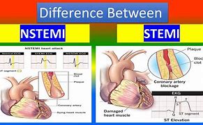 Image result for STEMI vs NSTEMI ECG