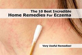 Image result for Eczema Treatment Home Remedy
