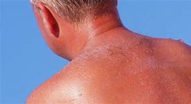 Image result for Skin Cancer From SunBurn