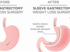 Image result for Stomach Surgery to Lose Weight