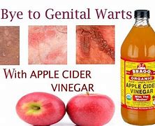 Image result for Removing Genital Warts