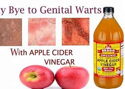 Image result for Get Rid of Genital Warts