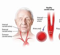 Image result for Carotid Artery in Neck Location