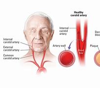 Image result for Left Internal Carotid Artery