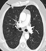Image result for Subpleural Lung Nodule