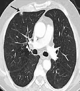 Image result for 12Mm Nodule in Lung