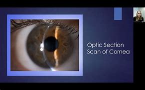 Image result for Corneal Layers Slit Lamp