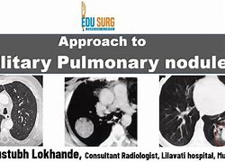 Image result for Solitary Pulmonary Nodule Lung Folow Up