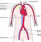 Image result for Central Venous Access Catheter