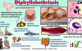 Bildergebnis für diphyllobothriosis
