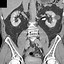 Image result for Cyst in Kedney