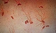 Image result for Typhoid fever