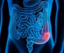 Image result for Tumor On Outside of Colon