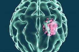 Image result for Brain Tumor Headaches