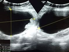 Image result for Ovarian Dermoid Cyst