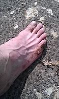 Image result for Grapes sunburn