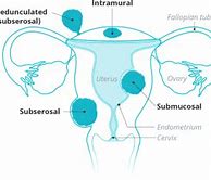 Image result for 6 Cm Fibroid