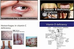 Image result for deficiencis