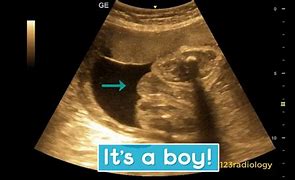 Image result for 4 Month Ultrasound Boy