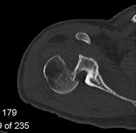 Image result for Carotid Endarterectomy Scar