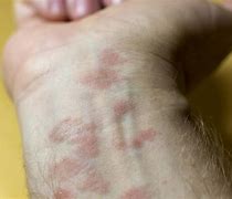 Image result for Eczema Bumps On Arms