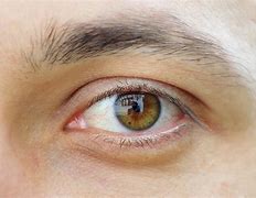 Image result for Corrective Eye Surgery