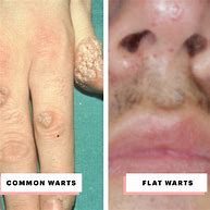 Image result for What Are Warts On Hands
