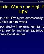 Image result for Warts HPV Virus in Women