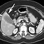 Image result for Gallbladder Mass CT