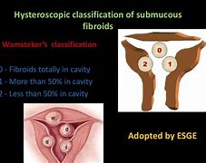 Image result for Submucous Fibroid