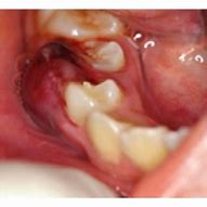 Image result for Gingival Abcess OPG