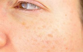 Image result for âge Spots Symptoms