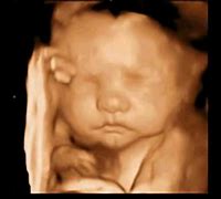 Image result for Carotid Ultrasound