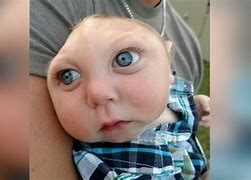 Image result for Infant Born without Full Skull