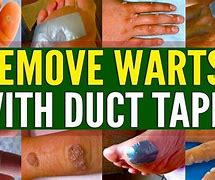 Image result for Duct Tape Warts Nail Polish