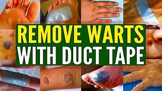 Image result for Plantar Warts On Feet Duct Tape
