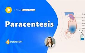 Image result for Paracentesis Infection