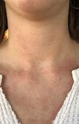 Image result for Food Allergy Rash Ches